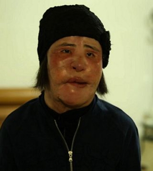 선풍기 아줌마 근황 "잘 때 눈 여전히 못 감아"...누리꾼들 ''안타깝다''