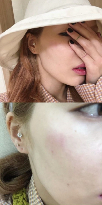 현아, 대학축제 무대서 넘어져 얼굴 부상…“걱정 끼쳐 미안”